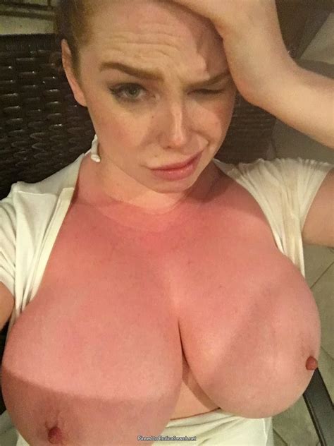 Sophie Coady S Sunburnt Boobs Eroticasearch Net