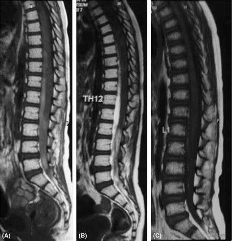 Spinal Epidural Hematoma