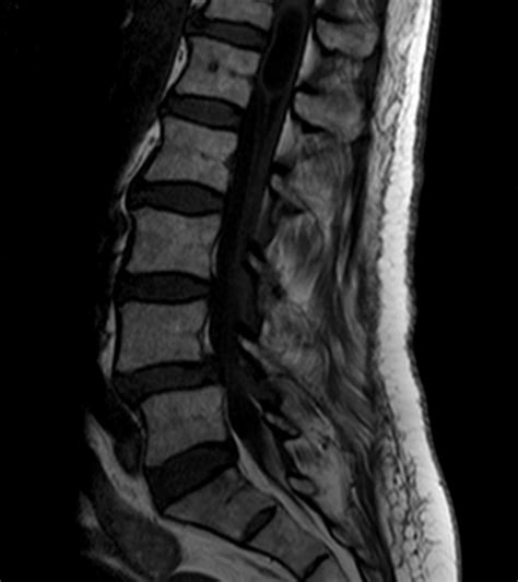 Cystic Cavity Located In The Conus Medullaris Of An Adult Eurorad