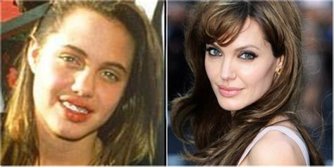 Angelina Jolie Surgeries Before And After Celebrity