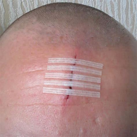 How Do Wound Closure Strips Work First Aid Online