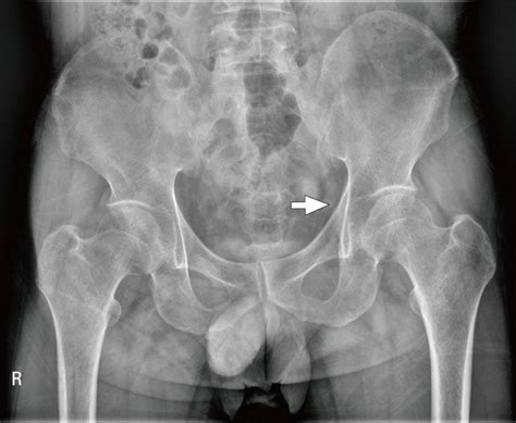 Simple X Ray Of Pelvis Showed Osteopenia Suspicous Cortical Disruption