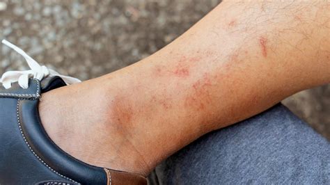 Rash On Legs Causes And Treatment