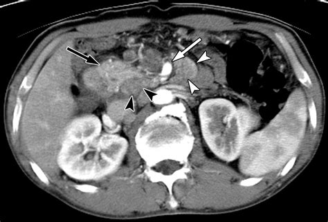 Ct And Pet In Stomach Cancer Preoperative Staging And Monitoring Of