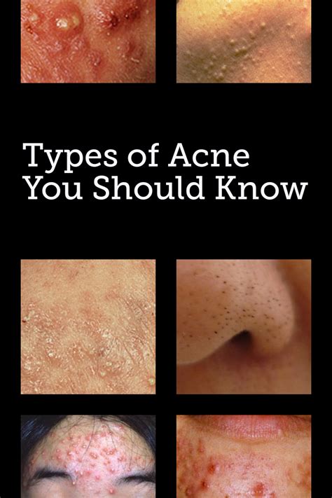 Acne Types How To Recognize What Kind Of Acne You Have In 2020 Types