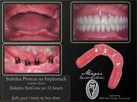 Proteza Na Implantach Ca Kowite Bezz Bie Magic Dental Studio