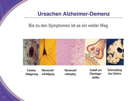 Ppt Alzheimer Demenz Powerpoint Presentation Free Download Id4612621