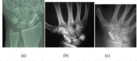 Figure 1 From Treatment Of Failed Scaphoid Nonunion Fixation Using Free