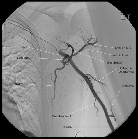 Labeled Angiogram Of Arm
