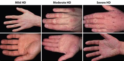 Chronic Hand Dermatitis A Practical Guideline For General Practitioner 2024