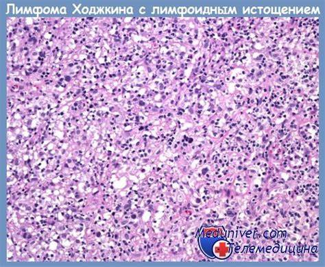 Диета при лимфоме не ходжкина Лимфоидное истощение при лимфоме Ходжкина - диагностика Лимфоидное истощение при лимфоме Ходжкина - диагностика Диета при лимфоме не ходжкина