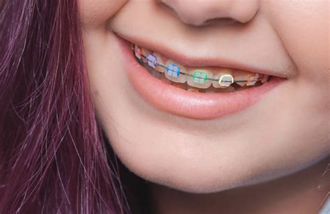 Landl Orthodontics Looking To The Future With 3d Printed Braces Lavrin And Lawrence Orthodontics