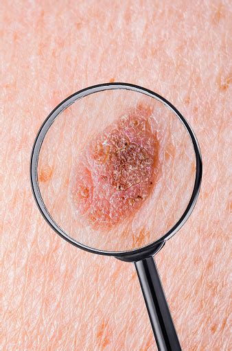 Skin Mole Defect High Magnification Macro Photo For Medical Diagnosis