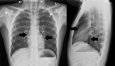 Chest Radiograph Pa And Lateral Views Pa Posterior Anterior The Download Scientific Diagram