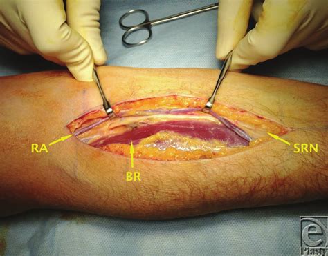 Anterior Approach To Posterior Interosseous Nerve Decompression