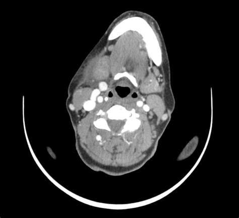 Swollen Right Submandibular Area Figure 2 Contrast Ct Scan Of The