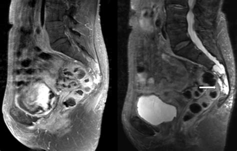 Cureus Surgical Management Of Sacral Chordomas Illustrative Cases