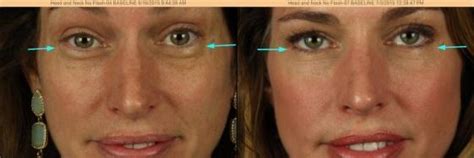 Botox Under Eye Bags Dana Point Ca Dana Point Dermatology