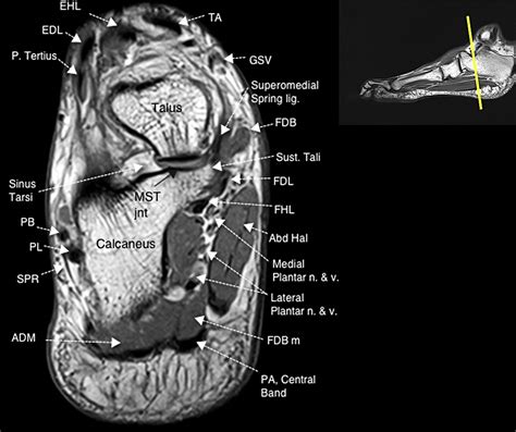 Foot Muscles Mri Anatomy Mri Ankle Anatomy Ankle Anatomy Anatomy