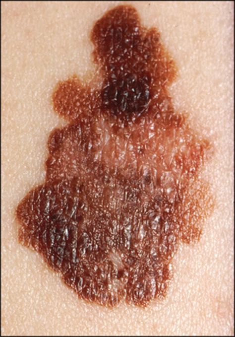 Excision Margins For Melanomas How Wide Is Enough The Lancet Oncology