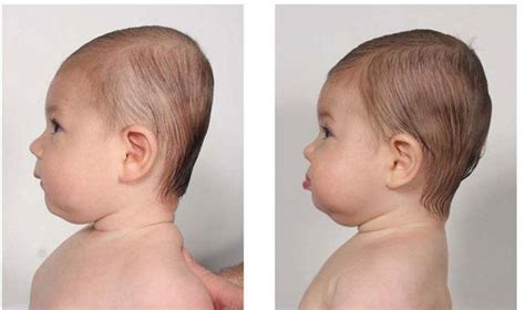 More Parents Ignore Sids Guidelines To Prevent Flat Head