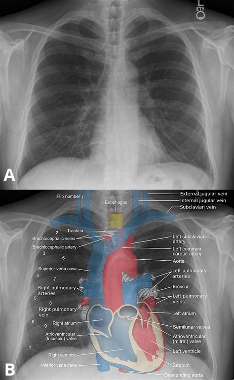 Normal Chest Xray Labeled