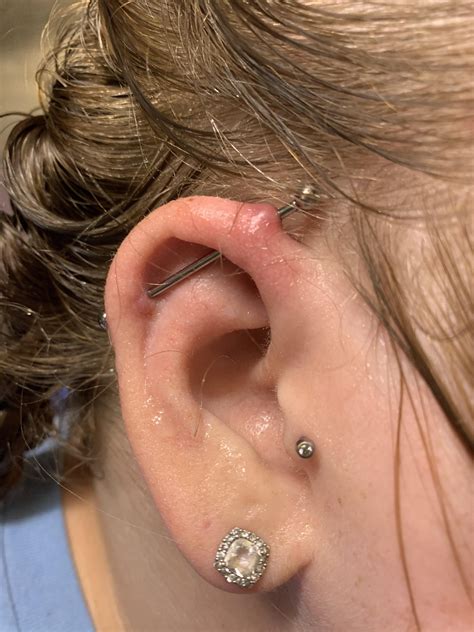 Help With Irritation Bump Rpiercing