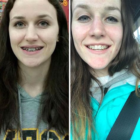 114 Incredible Before And After Transformations Of People Who Wore Braces After Braces Braces