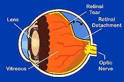 Check spelling or type a new query. What is Retinal Detachment, Torn, Detached Retina ...