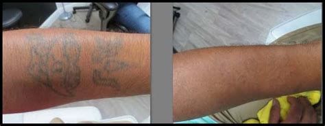 Tattoo vanish changed my life forever. Vanish Medical Spa | The Best Laser Tattoo Removal ...
