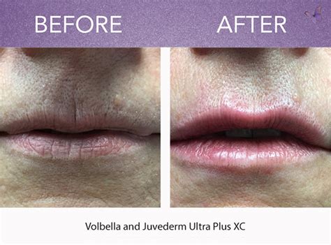 JuvÉderm ® Volbella Xc Facial Filler Derma Health Institute Lost