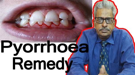 Pyorrhea Discussion And Treatment In Homeopathy By Dr Ps Tiwari