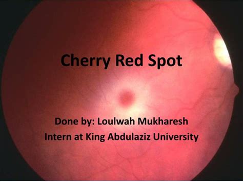Sialidosis (type i = cherry. PPT - Cherry Red Spot PowerPoint Presentation, free ...