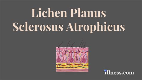 Lichen Planus Vs Sclerosus My Xxx Hot Girl