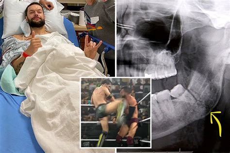Wwe Star Finn Balor Shows Off Horror Broken Jaw In Cracked X Ray As Nxt