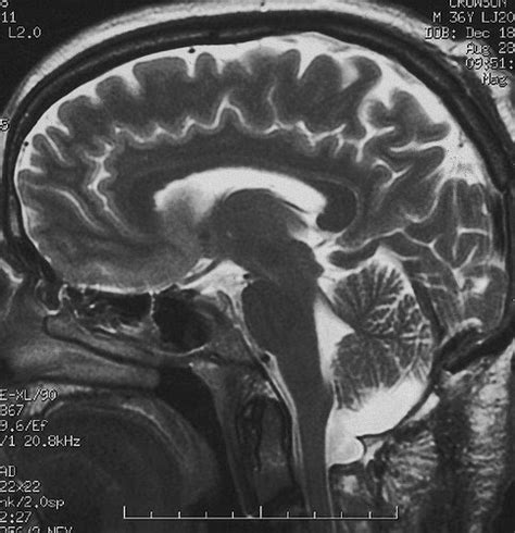 Traumatic Brain Injury Tbi Causes Signs And Symptoms Minnesota