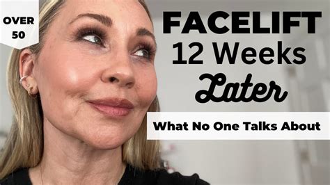 Facelift 12 Weeks Later All The Details Youtube