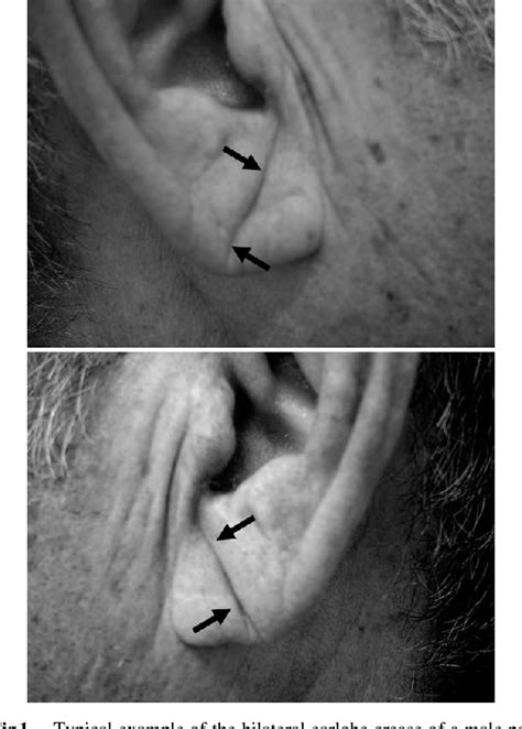 Figure 1 From Diagonal Earlobe Crease Are Associated With Shorter