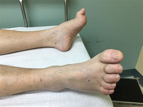 While each of these affects slightly toe length: Молоткообразная деформация пальца стопы - Hammer toe - qaz ...