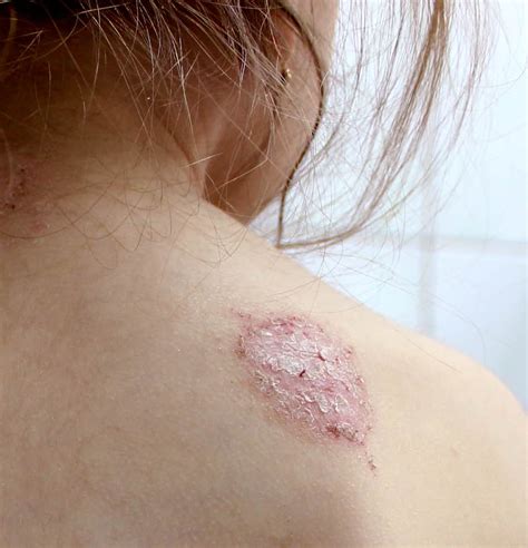 What Are The Different Types Of Dermatitis Important Facts