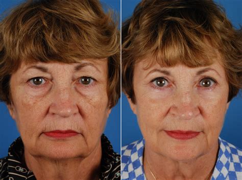 Before And After Blepharoplasty Eyelid Surgery Rejuvenation Surgery