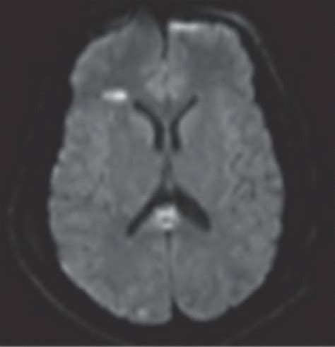 Diffuse Axonal Injury Radiology Key