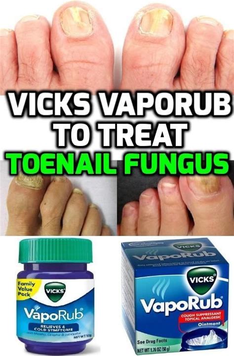 We've heard that vicks vaporub can cure toenail fungus before (it's also helpful when you've got a cold!), but the new york times recently put it to. Vicks Vaporub contains antimicrobial, anti-inflammatory ...