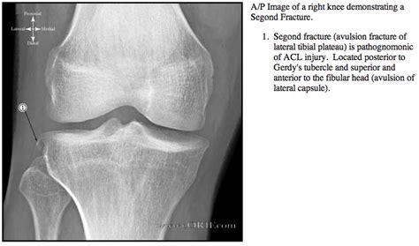 Tibial Plateau Fracture Icd 10 Asking List