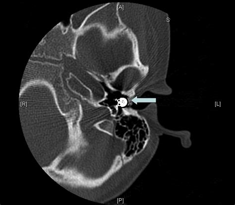 Lost Foreign Body In The Ear Journal Of Emergency Medicine
