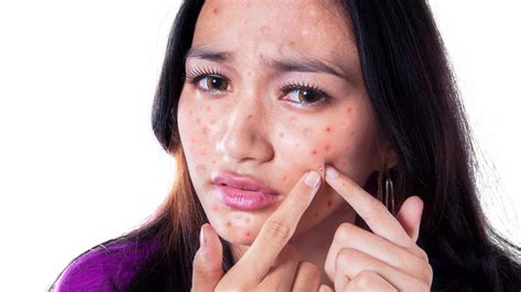 6 Types Of Pimples On The Face And How To Treat Them Muy Salud