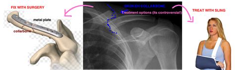 Does Surgery For A Broken Collarbone Have Good Results — Bone Talks