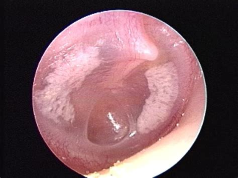 Tympanic Membrane Retraction