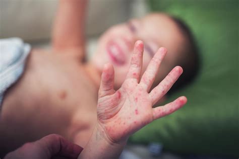 Hand Fuß Mund Krankheit Elternde