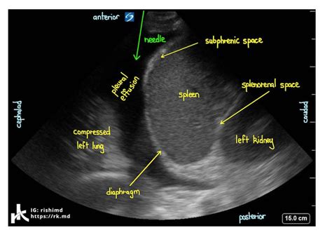 Ultrasound Pleural Effusion And Spine Sign Rkmd